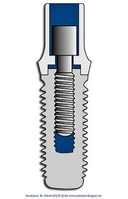 Implantante - Verankerung