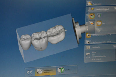 Cerec, Monitordarstellung, Zahnersatz, Implantologe, Zahnarzt, Bochum