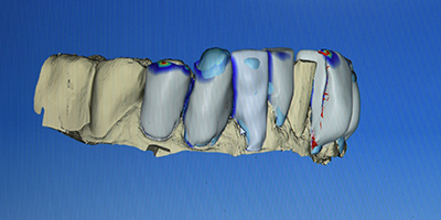 06 cerec veneer02